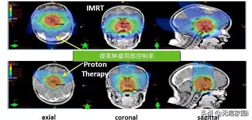 头部肿瘤质子放疗长期毒副作用,质子放疗对什么肿瘤效果不明显