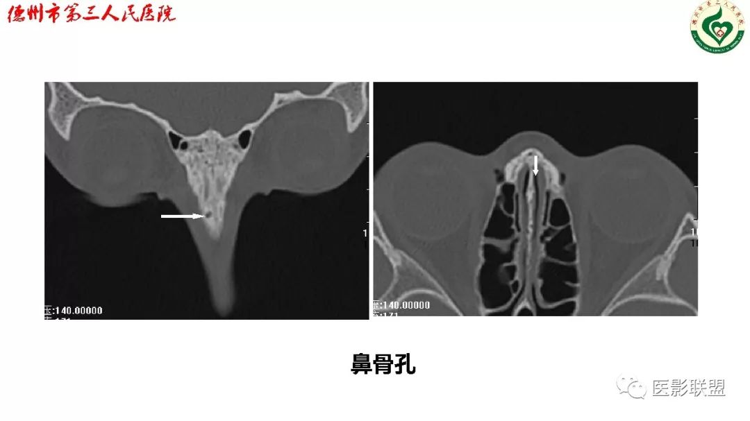 鼻骨骨折影像,鼻骨骨折dr影像表现