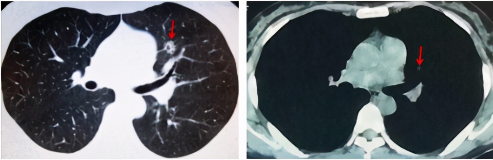 乳腺癌转移到肝医生说动不了手术,乳腺癌肺转移不放化疗可以治吗