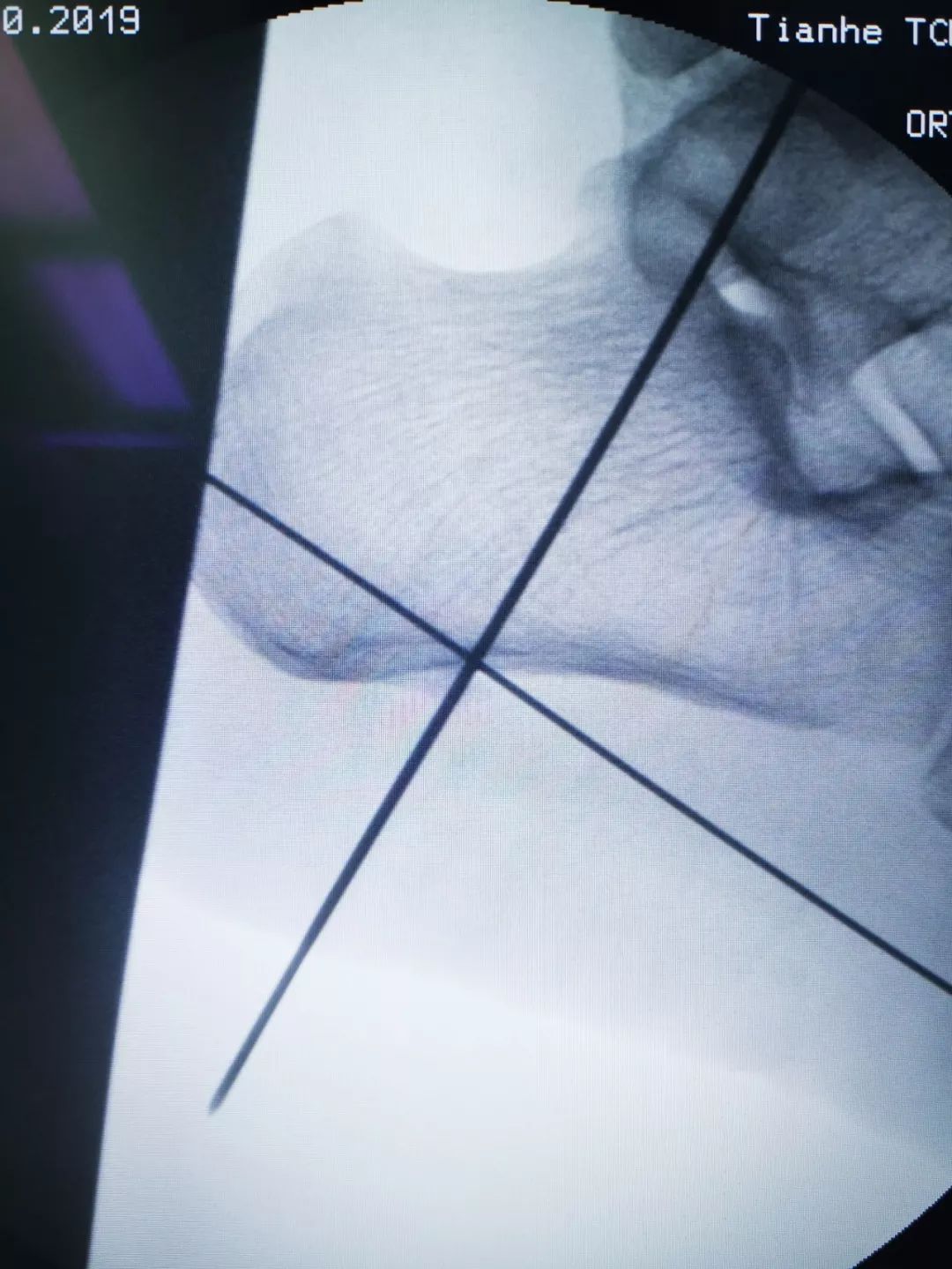 广州天河区中医院骨伤二科成功实施关节镜下跟骨骨刺摘除术