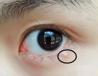 脂肪粒该如何消除,脂肪粒怎么办才能消除