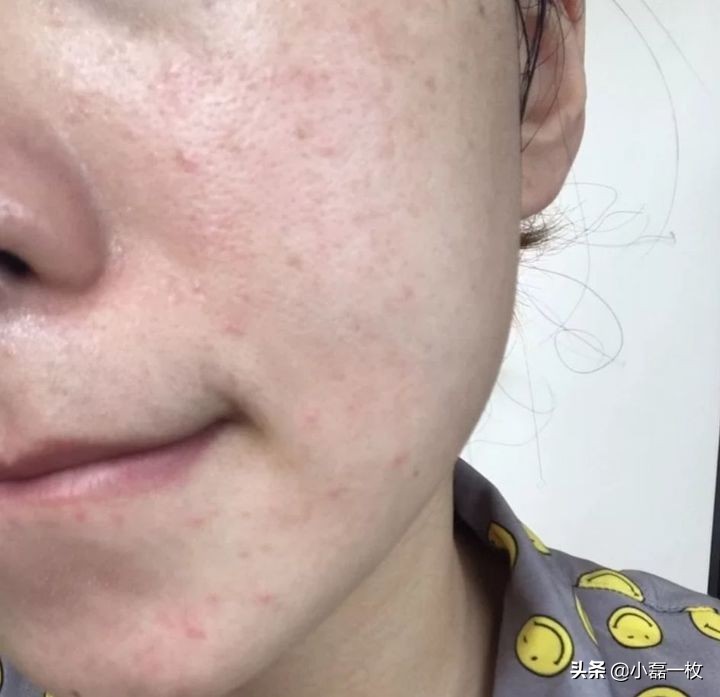 有哪些好用的祛痘印的产品,有哪些比较好的祛痘印产品