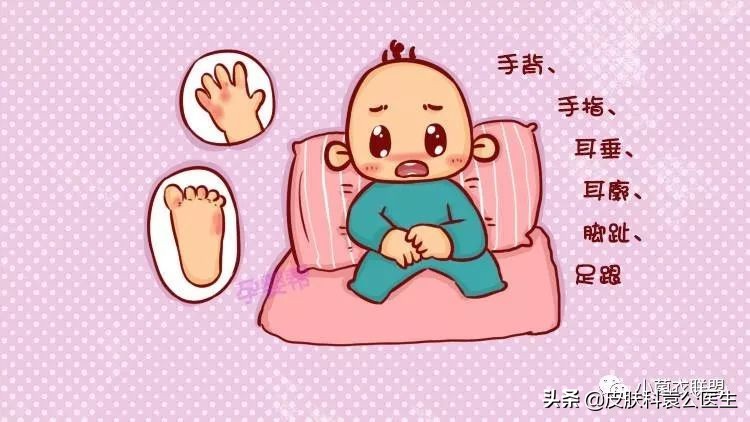 冻疮后期接触水干燥发痒怎么治,冻伤痒痛