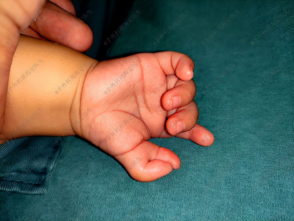 婴儿手拇指多指几个月适合手术,六个月宝宝手拇指多指