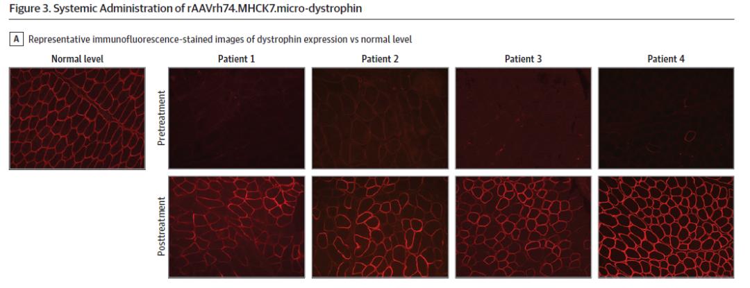 dmd基因治疗最新进展,dmd基因疗法
