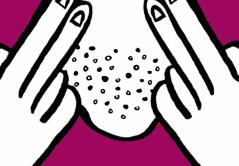 “毛孔粗大”粗的并不是“毛孔”,它是瘢痕呀！三种方法有效解决