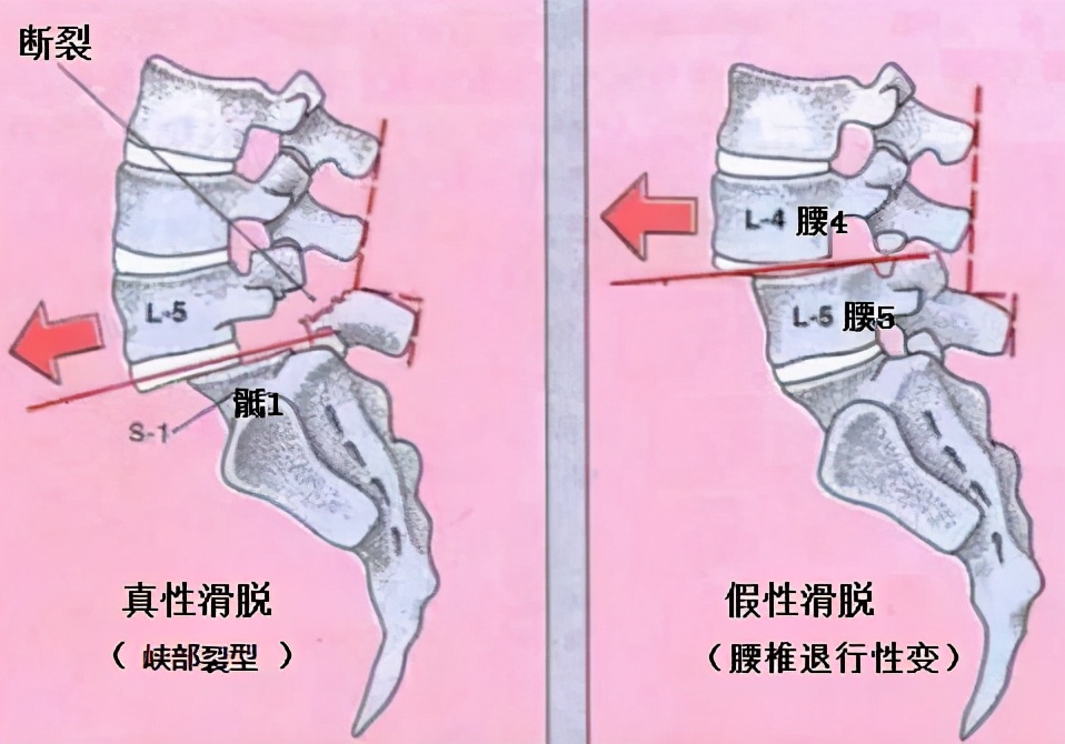 腰痛要警惕四种原因腰椎肿瘤,腰痛引起腰椎滑脱怎么治