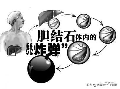 泥沙状胆囊结石2mm吃药可以排出么,有泥沙的胆囊结石能做保胆取石