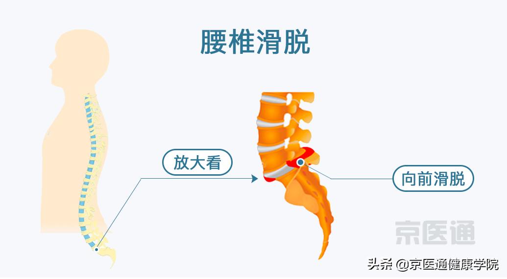 腰痛、腿痛是什么病？骨科医生用一块「羊蝎子」告诉你