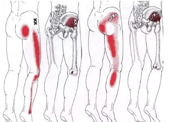 运动解剖学臀小肌,运动解剖学髂腰肌照片