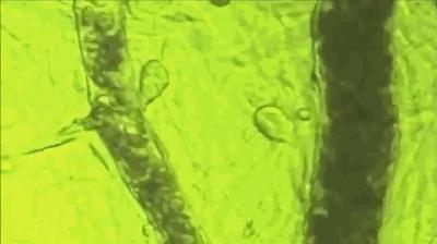冠脉狭窄30为什么胸痛,冠心病没有冠脉狭窄胸痛