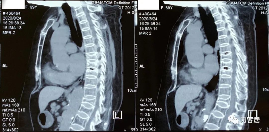 脊柱骨质疏松性压缩性骨折,老年骨质疏松压缩性骨折诊治