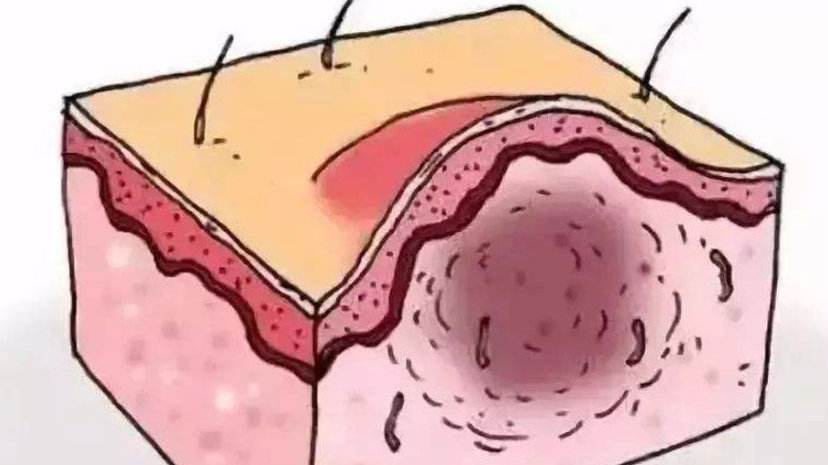 头发又油又痒还长痘痘是什么原因,14岁男孩头发里长痘痘怎么回事