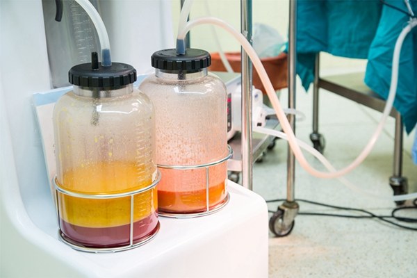 抽脂减肥最佳方法,抽脂后怎么减肥最有效