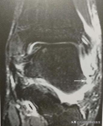 小孩脚踝麻麻的感觉怎么了,小孩常见的脚踝问题