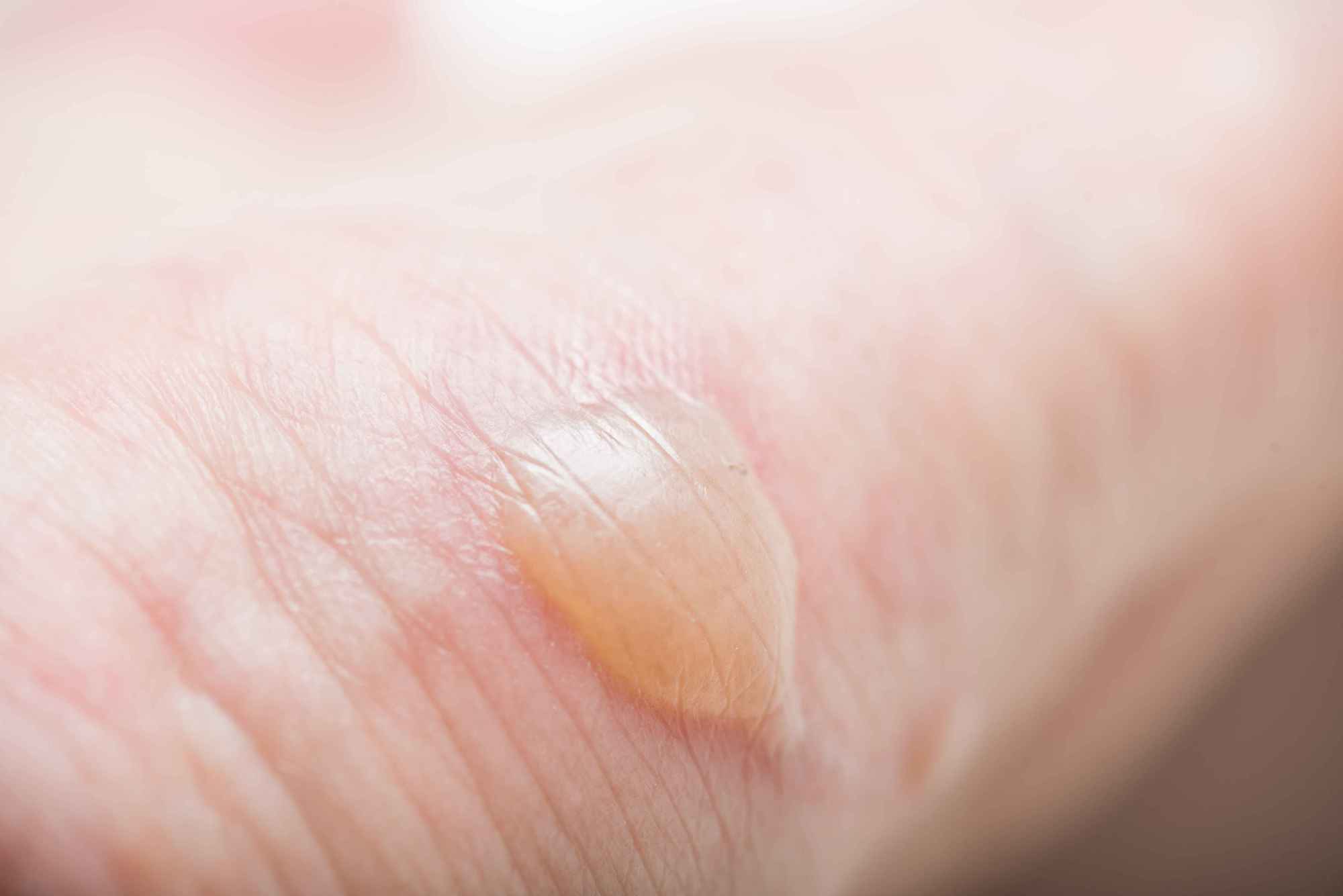 烧烫伤的处理方法和注意事项,烧烫伤的正确处理方法