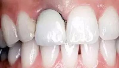 为什么做了烤瓷牙的人都后悔,烤瓷牙套弄上后悔了该怎么办