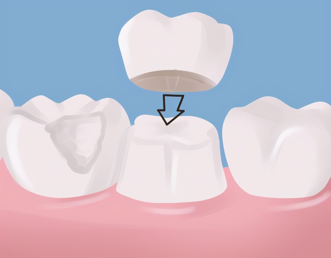 做了根管治疗后,该怎么选择牙冠?有哪几种修复方式可选?