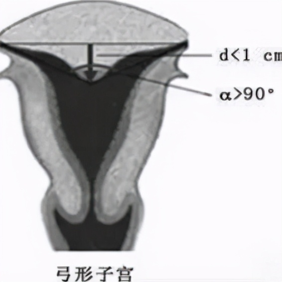 专家介绍子宫畸形种类,子宫疾病的介绍