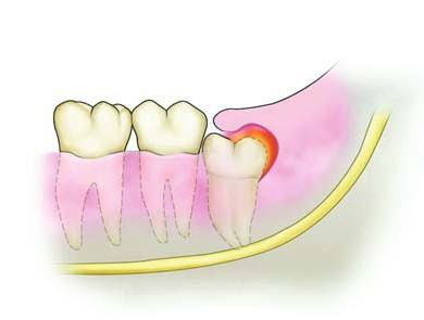 牙疼怎么办快速缓解小方法,牙疼漏神经了怎么快速缓解疼痛