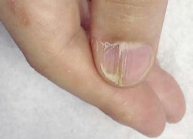 宝宝指甲出现白点,孩子指甲上有白色斑点倪海厦