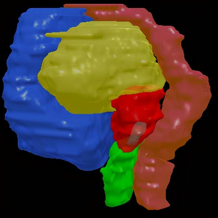 宫颈癌骨转移最好的治疗方案,宫颈癌术后转移到卵巢怎么治疗