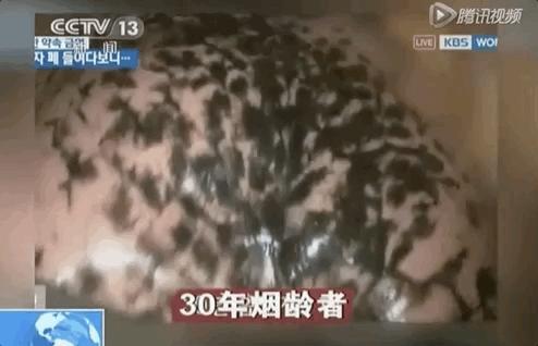 打开死者的肺，才明白有3亿人，在悄悄花钱买死