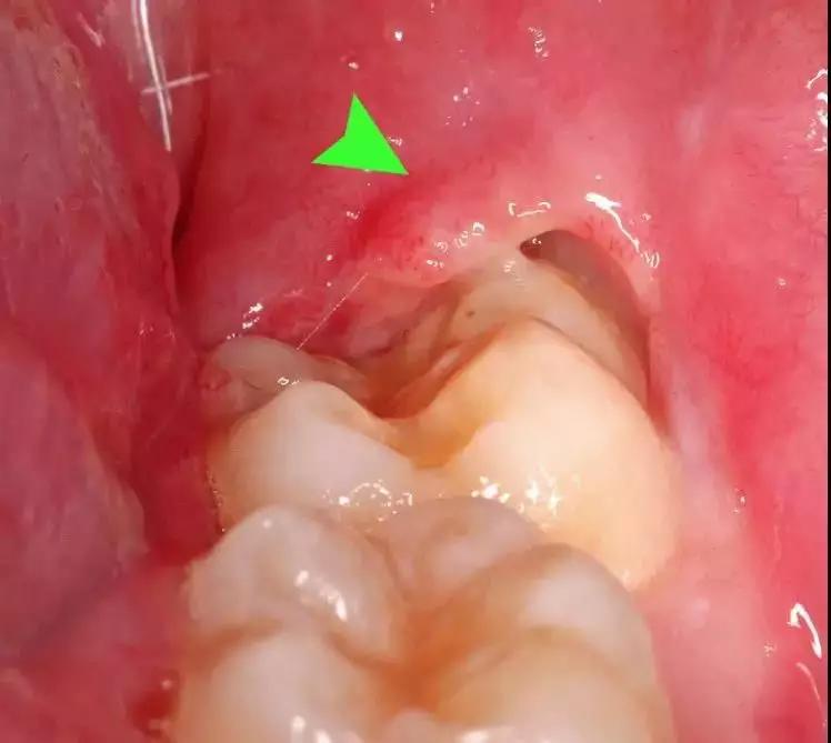 有没有智齿不拔的案例,我有个智齿没长出来怎么拔