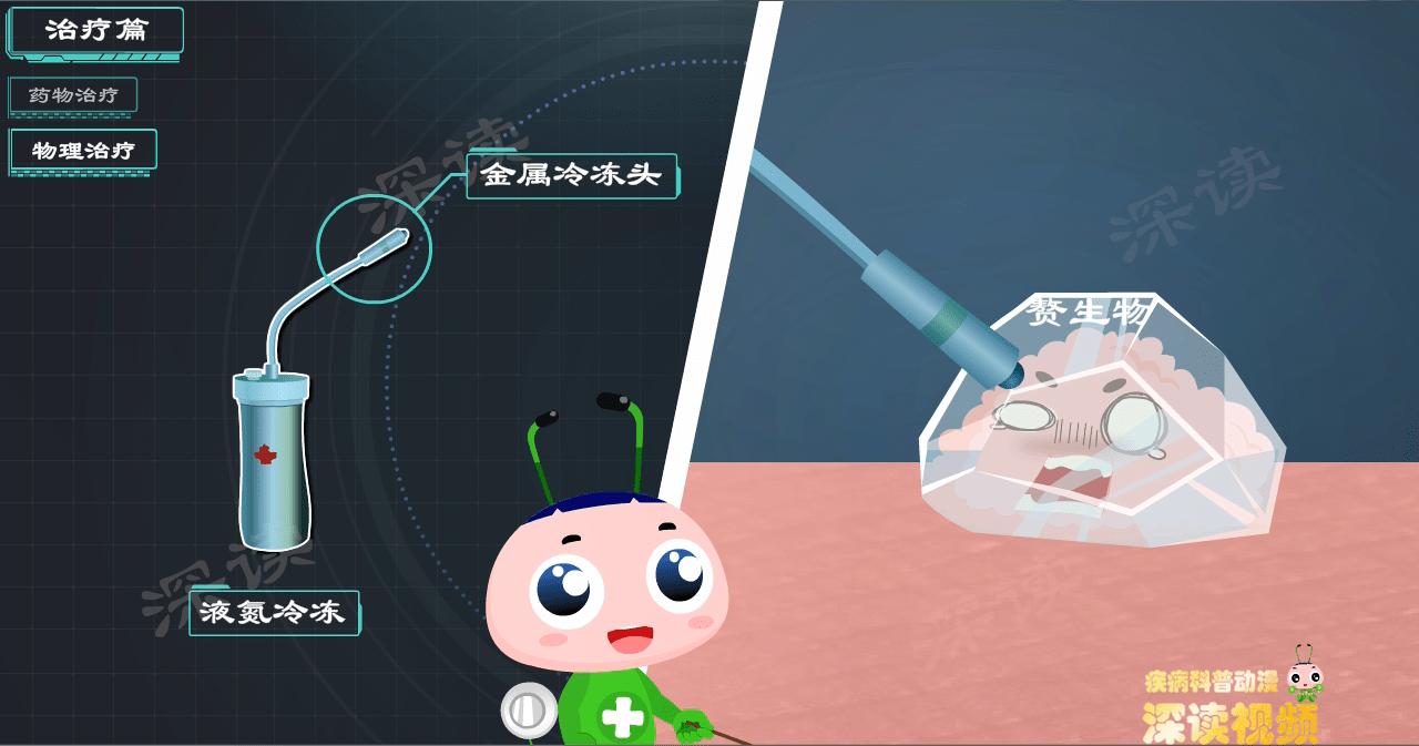 液氮冷冻治疗尖锐湿疣没感觉,液氮冷冻治疗尖锐湿疣注意事项