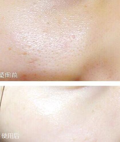 毛孔粗大肤质差如何去收缩毛孔,遮毛孔粗大收缩毛孔最有效的方法