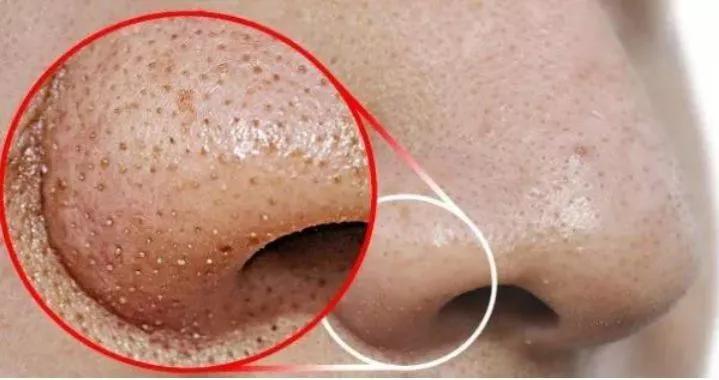 专治螨虫的洗面奶,螨虫专用洁面乳