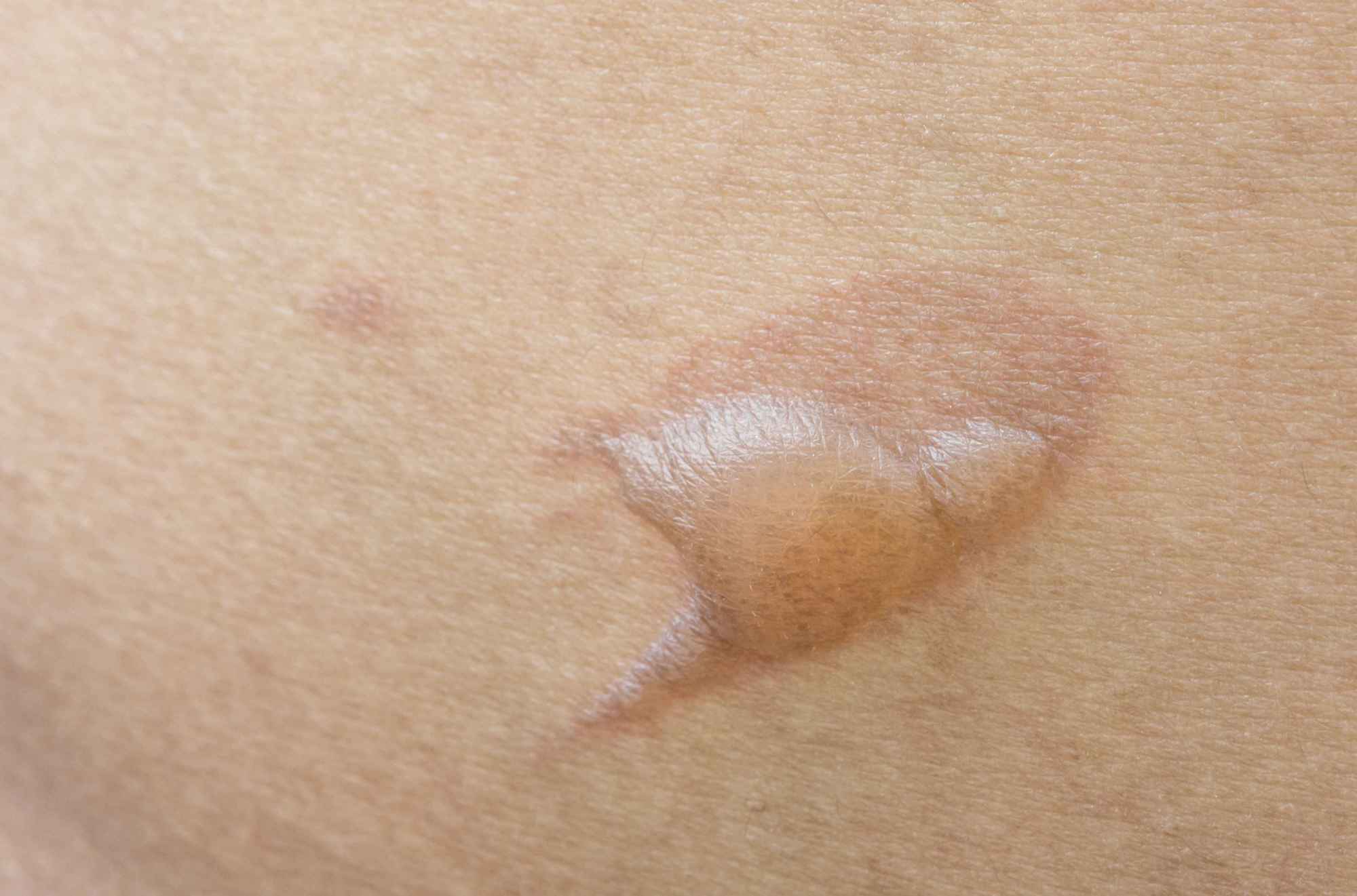 烧烫伤的处理方法和注意事项,烧烫伤的正确处理方法