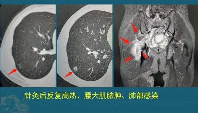化脓性细菌感染用什么抗生素,化脓性细菌感染有痰用什么抗生素