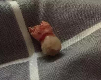 拔智齿痛到怀疑人生,拔了智齿痛的怀疑人生