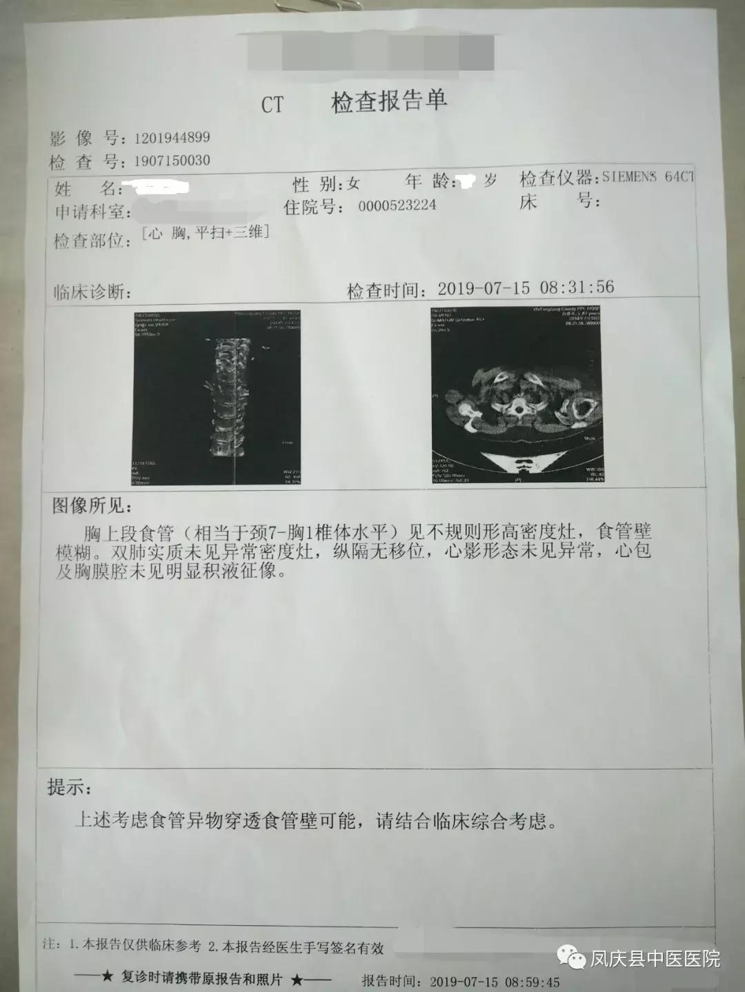 凤庆中医：谨慎“吃鸡”，食管异物取出化危急