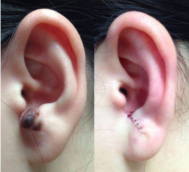 黑色素痣用激光还是手术,痣是手术切除好还是激光好