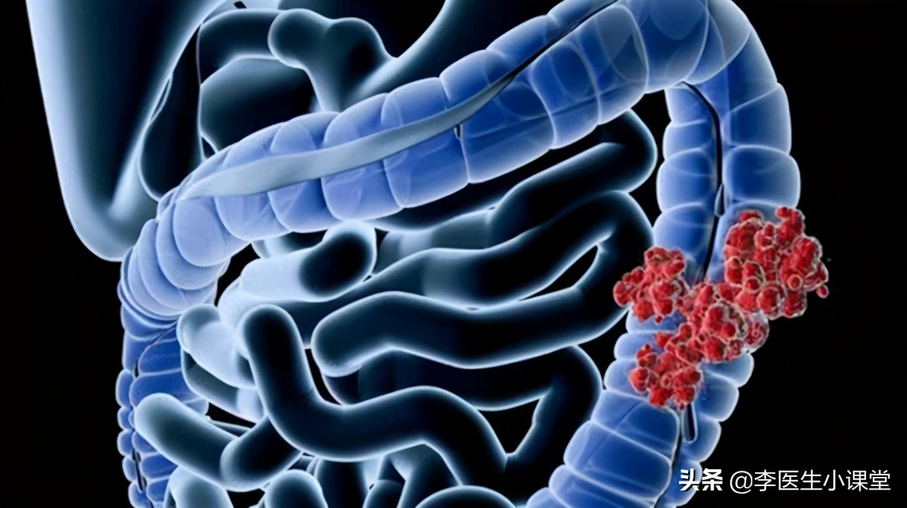 肠癌的6个早期症状治疗方法,肠癌来临前会先经历哪三个症状呢