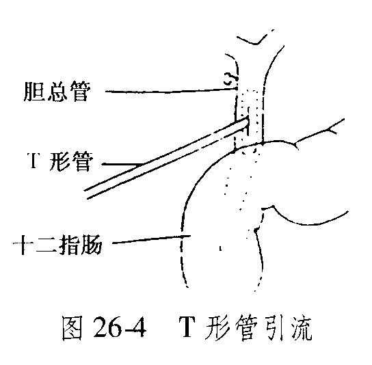 胆管切除后t管脱出怎么办,胆管手术t管脱落有什么症状
