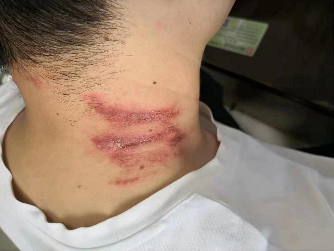 40岁女人脸被隐翅虫烧伤毁容吗,隐翅虫碰到脸上了是不是会毁容