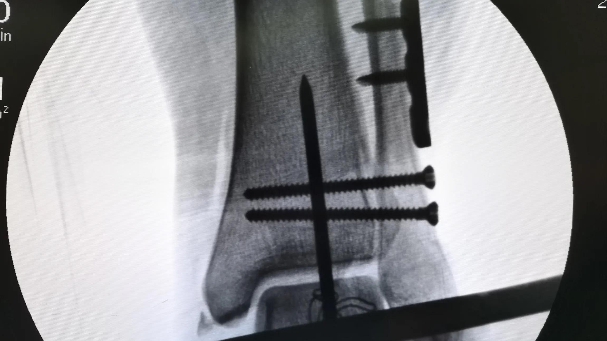 股骨粗隆骨折术后钢板取还是不取,锁骨骨折术后三个月可以取钢板吗