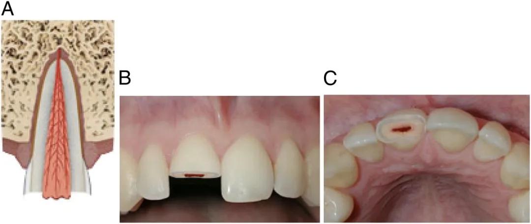 宝宝磕到牙会伤到神经吗,宝宝磕掉乳牙还能再长吗