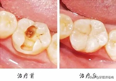 根管治疗牙齿什么样,根管治疗的牙齿是什么