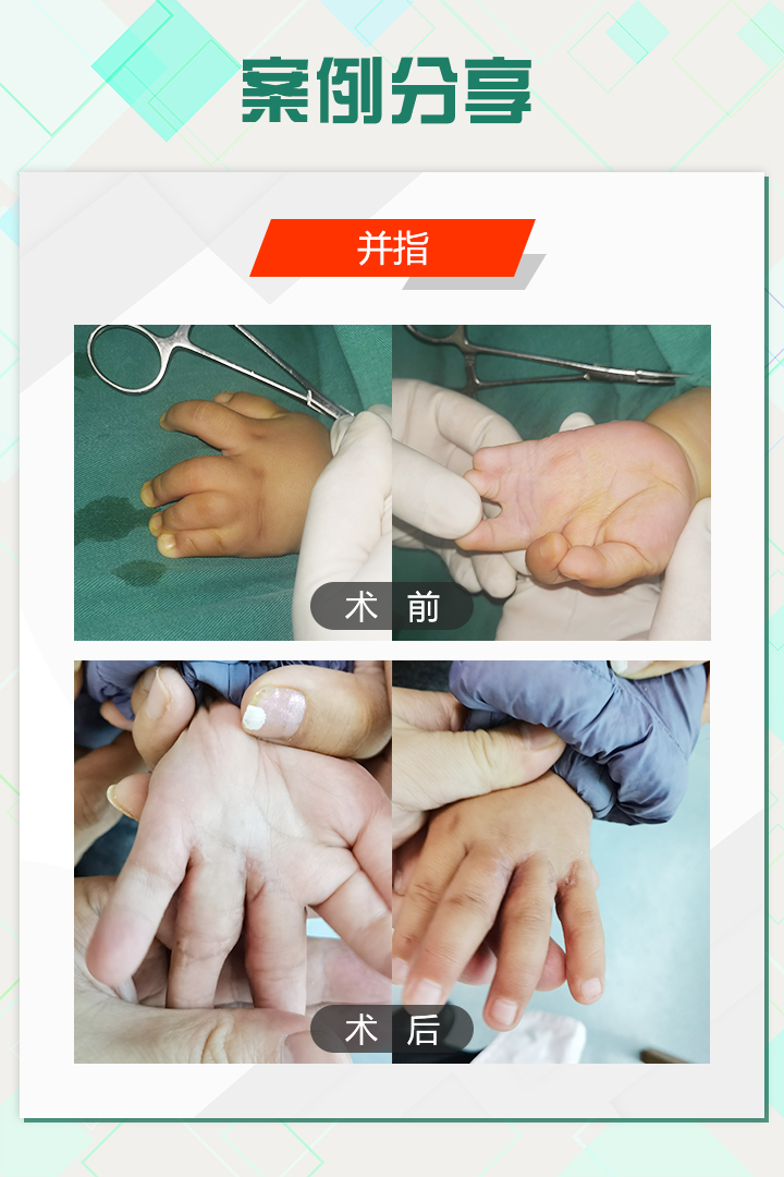 手足外科陈江海微博,手外科专家陈江海