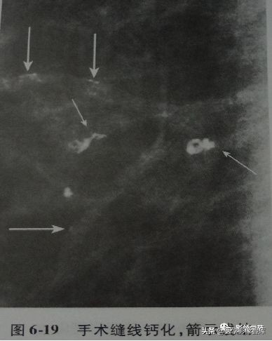 乳腺钙化怎么区分良性和恶性,乳腺钙化的诊断与分级