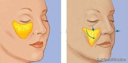 注射泪沟淤青一般需要几天好,胶原蛋白注射泪沟淤青多久能好