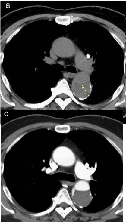 如何监测动脉夹层早期,动脉增强ct能查出主动脉夹层么
