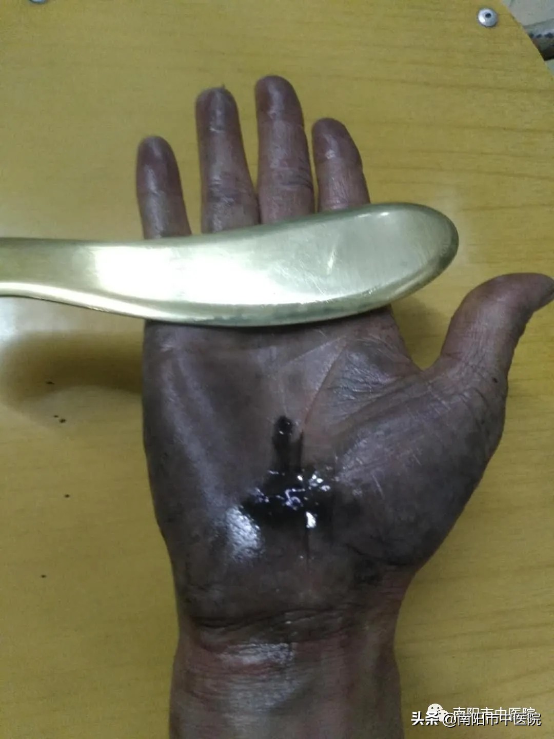 南阳市中医院开展多种中医特色治疗项目——虎符铜砭刮痧