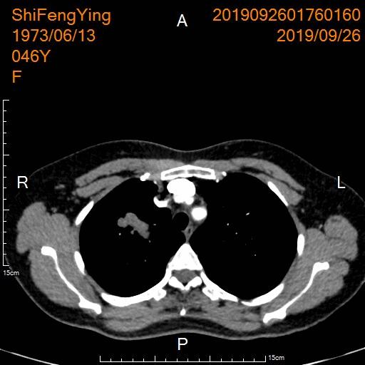 肺神经内分泌癌早期手术好吗,肺部神经内分泌肿瘤治疗