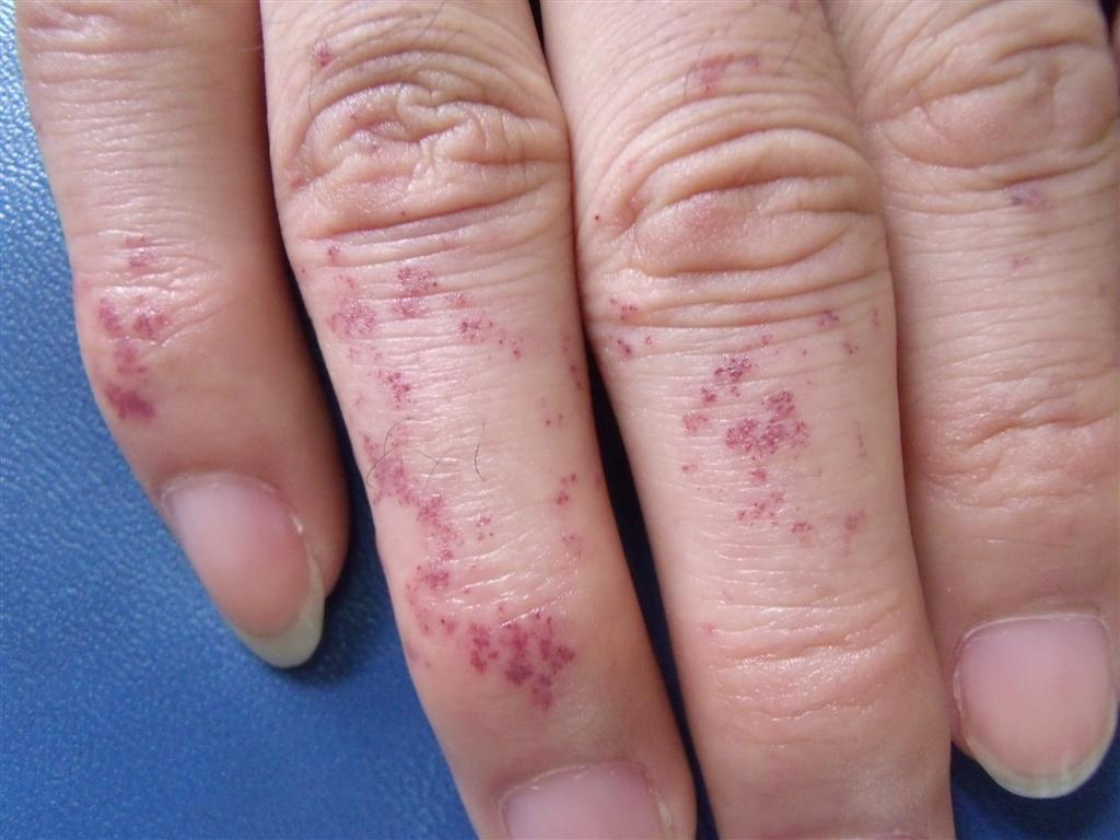 认识常见妇科肿瘤,外阴血管瘤成因