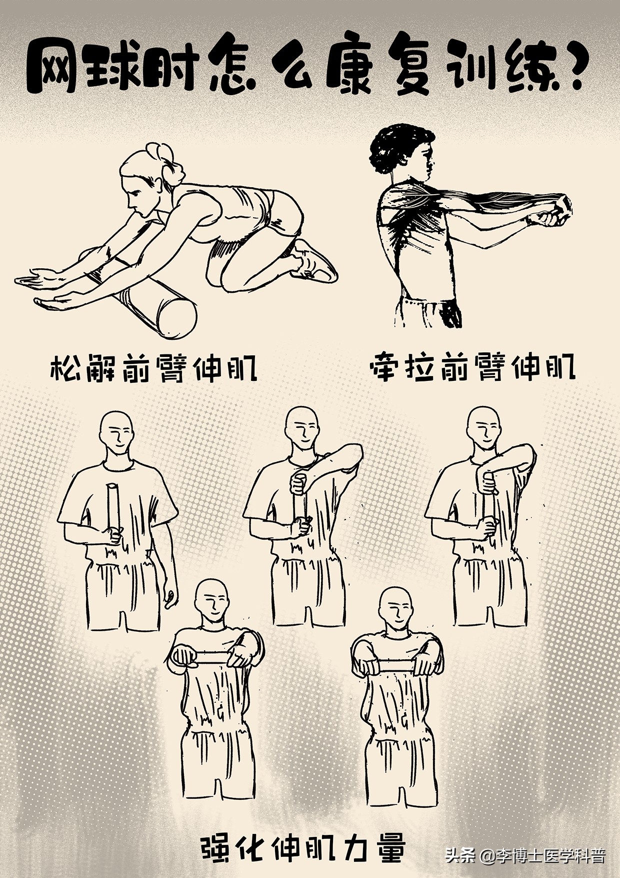 网球肘和高尔夫球肘会同时得吗,网球肘和高尔夫肘如何防治